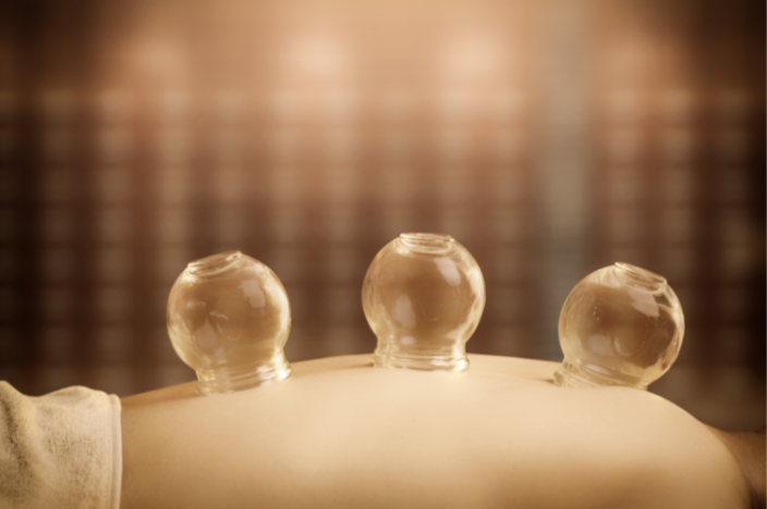 Why Is Cupping Therapy Popular?